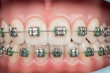 Braces and Orthodontics Agra