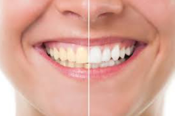 Cosmetic Dentistry Agra