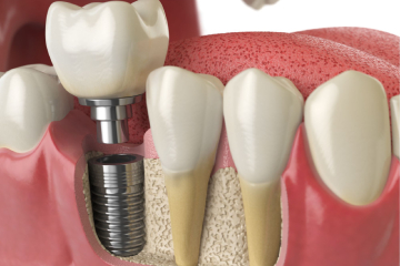 Dental Implants Agra